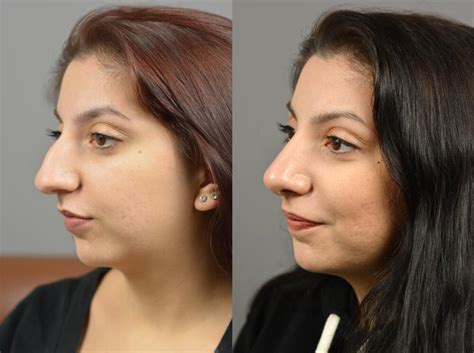 Nose Surgery Before And After Patient 18 Dr Marotta
