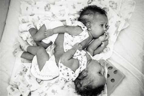 Photographer Captures The Beauty Of Conjoined Twins Popsugar Moms Photo 9
