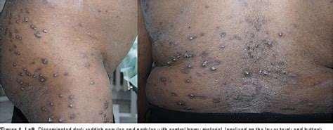 Pdf Acquired Perforating Dermatosis Associated With End Stage