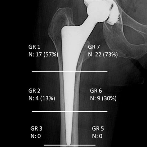 Distribution Of Femoral Osteolysis According To Zones Described By