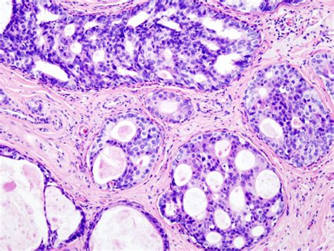 Non Invasive Breast Cancer Ductal Carcinoma In Situ Dcis — Diagnosis
