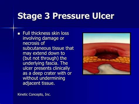 Stage Iii Pressure Ulcer