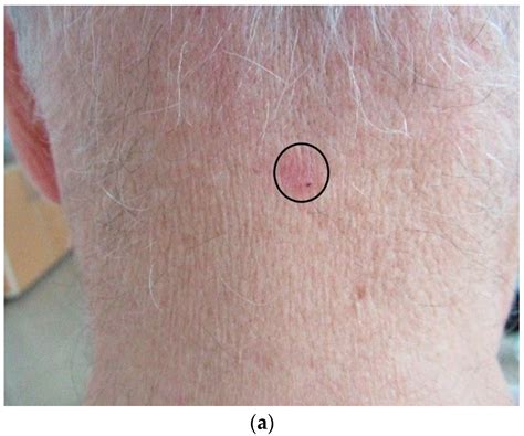Diagnostics Free Full Text Assessment Of Basal Cell Carcinoma Using