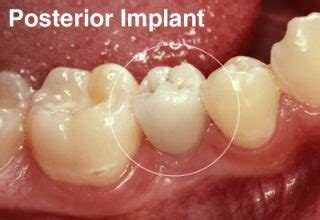 Tooth Replacement Dental Implant Posterior Implant