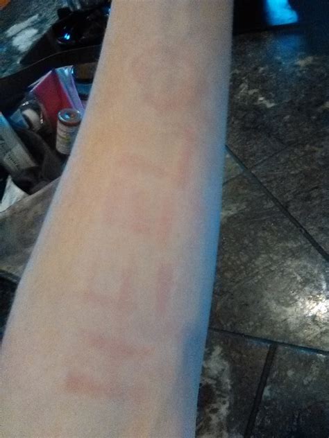 16 Photos That Show What Dermatographism Looks Like