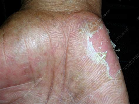 How I Treated My Pompholyx Eczema Dyshidrotic Dermatitis Patients