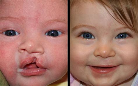 Primary Cleft Lip And Nasal Reconstruction Gallery St Louis Childrens