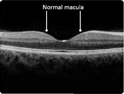 Macular Hole Macula Retina Vitreous Center