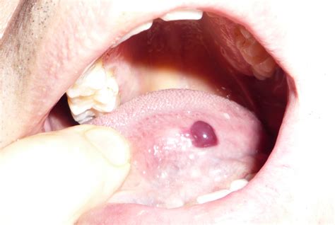 Blood Blister In Mouth Causes And Remedies