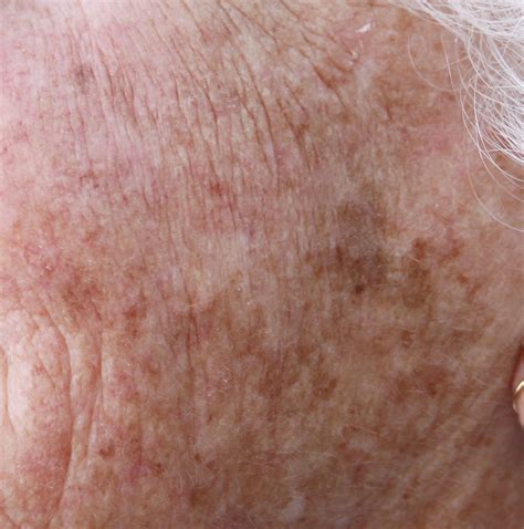 Aging And Sun Damaged Skin Arlington Skin Doctor