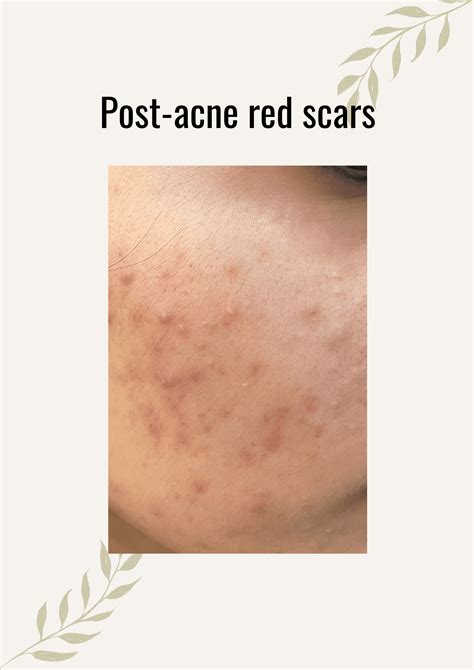 Red Acne Scars Treatment Dermatocare