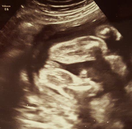 Afraid Of Wrong Gender On Ultrasound Babycenter