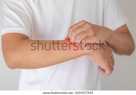 Man Itching Scratching On Arm Itchy Stock Photo 1654557244 Shutterstock