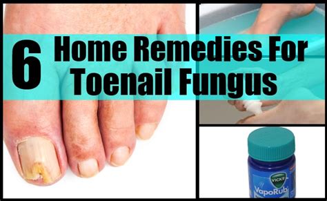 6 Home Remedies For Toenail Fungus Natural Cure And Herbal