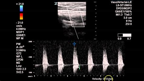 Bilateral Lower Extremity Arterial Duplex Case Study Youtube