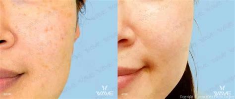Non Surgical Procedures Before And After Wave
