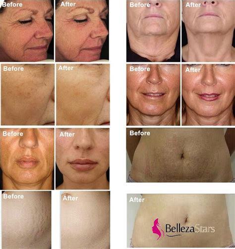 Microneedle Rf Fractional Device Used Before And After Microneedling Skin Tightening