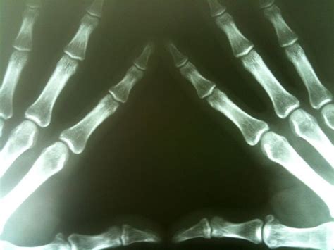 What You Need To Know About Metacarpal Fracture