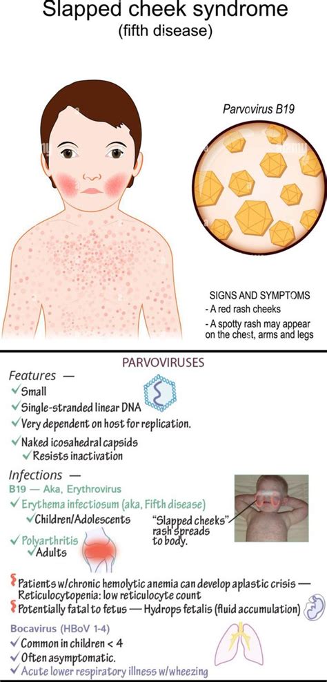 Sthanu On Twitter Erythema Infectiosum Also Known As Fifth Disease