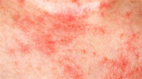 Eczema And Dermatitis The London Dermatologist