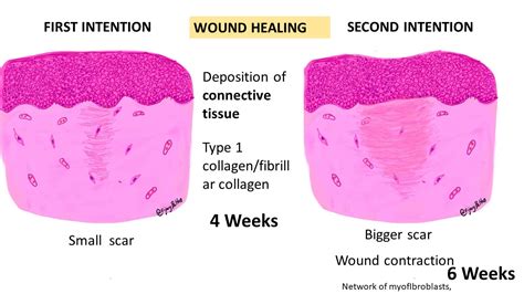 Tissue Repair Wound Healing Pathology Made Simple