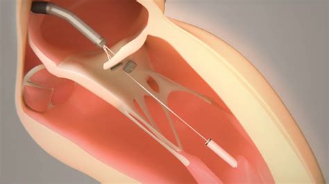 Transcatheter Mitral Valve Chord Repair By Pipeline Medical Youtube