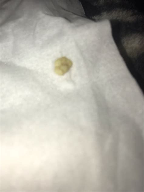 How Would You Get Rid If Tonsil Stones Glow Community