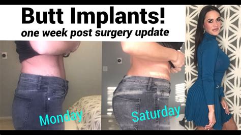 Butt Implants Photos Week After Surgery Weight Loss Surgery