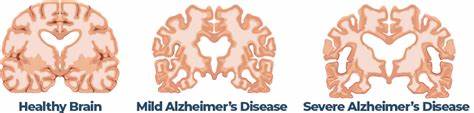 Alzheimer's can change mind designs in youth