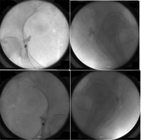 Treatment Of Radiation Induced Vulvar Pain Via Pudendal Nerve Block Under Fluoroscopic Guidance