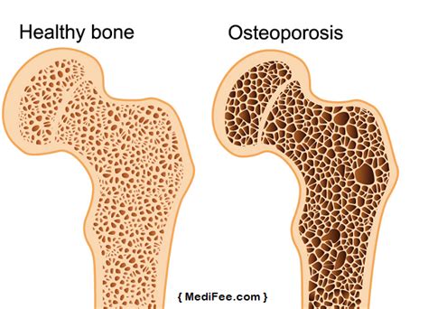 Osteoporosis Types Causes Diagnosis And Preventive Measures