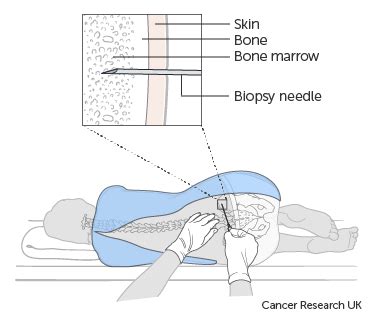 Bone Marrow Test Myeloma Cancer Research UK