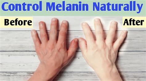 How To Reduce Melanin In Skin Naturally Melanin Kam Karne Ke Upay
