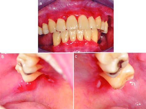 A Generalized Erythematous Gingiva Is Seen And B And C Blood Fi
