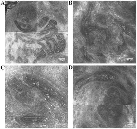 Vascular Patterns In Basal Cell Carcinoma Dermoscopic Confocal And
