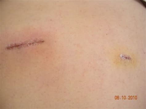 Is This Infected Warning Pic Of Incision Post Operation Lap Band