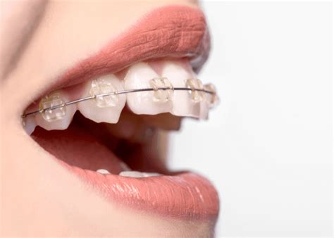 Teeth Straightening In Loughborough Loughborough Orthodonticsloughborough Orthodontics News