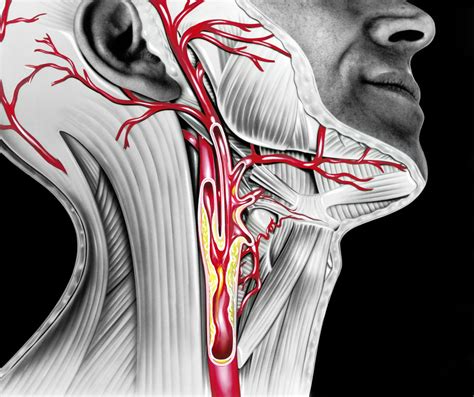 The carotid arteries can be felt on each side of the lower neck, immediately below the angle of the jaw. Carotid Stenosis Treatments