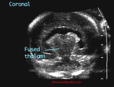 Holoprosencephaly Alobar Ultrasoundpaedia