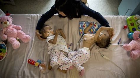 Mum Left Happy And Confused By Her Conjoined Twins Separation
