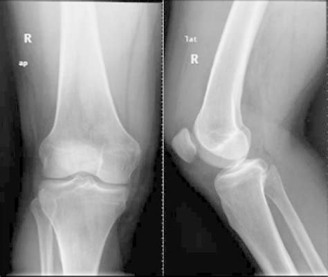 Normal Anteroposterior And Lateral X Ray Of The Right Knee Download