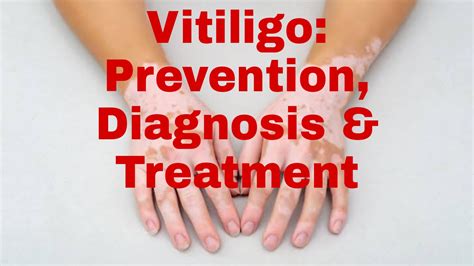 Vitiligo Prevention Diagnosis And Treatment Successyeti