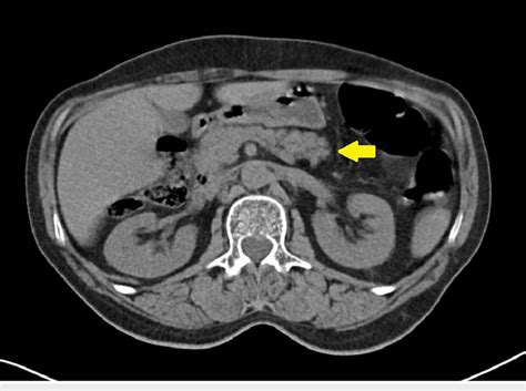 Abdominal Computed Tomography Without Contrast Demonstrating Pancreas