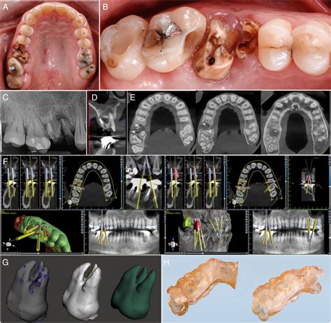 Autotransplantation Of Maxillary Third Molar With Its Attached Buccal