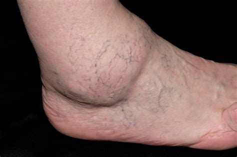 Osteoarthritis Of Ankle Photograph By Dr P Marazziscience Photo Library