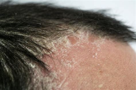 Whats The Difference Between Dandruff Psoriasis And Dry Scalp
