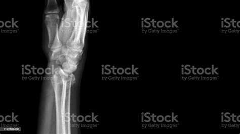 Film X Ray Wrist Radiograph Show Distal Forearm Bone Broken The Patient