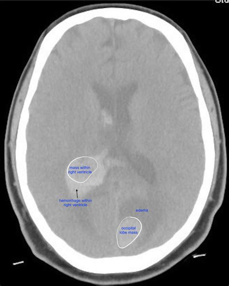 Cureus Acute Headache Due To Intracerebral Hemorrhage Secondary To