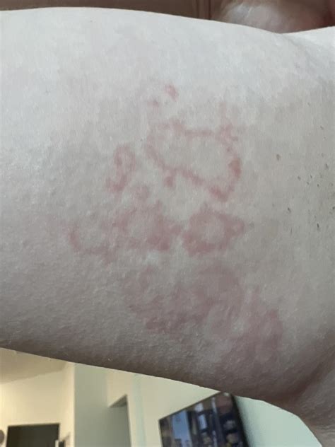 Weird Rash Cant Find Any Info About It Online Anyone Seen Anything