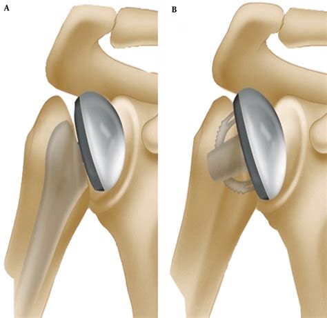 Learn vocabulary, terms and more with flashcards, games and other study tools. Two Types of Total Shoulder Arthroplasty; A, Conventional Total... | Download Scientific Diagram